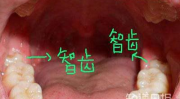 什么牙是智齿,揭秘第三磨牙的诞生与影响